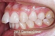 矯正歯科の症例４（上顎前突の症例）