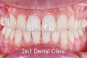 矯正歯科の症例４（上顎前突の症例）