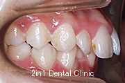 矯正歯科の症例５（上顎前突の症例）