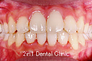 矯正歯科の症例５（上顎前突の症例）