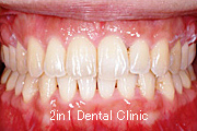 矯正歯科の症例６（上顎前突の症例）