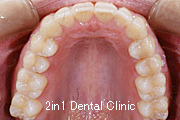 矯正歯科の症例６（上顎前突の症例）