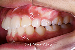 矯正歯科の症例７（上顎前突の症例）