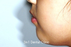 矯正歯科の症例７（上顎前突の症例）