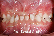 矯正歯科の症例８（下顎前突の症例）