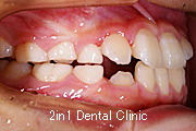 矯正歯科の症例８（下顎前突の症例）