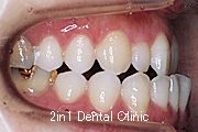 矯正歯科の症例９（下顎前突の症例）