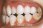 矯正歯科の症例９（下顎前突の症例）