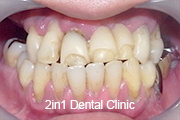 症例1　上顎⇒磁性アタッチメント＋チタン床義歯、下顎⇒レジン床義歯