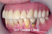 症例1　上顎⇒磁性アタッチメント＋チタン床義歯、下顎⇒レジン床義歯