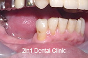 症例2　磁性アタッチメント＋ノンクラスプ＋チタン床義歯