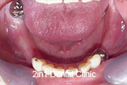 症例2　磁性アタッチメント＋ノンクラスプ＋チタン床義歯