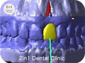 最終的な歯の形を３Ｄで構築