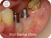 インプラント周囲に感染に強い硬い歯茎を再建