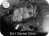 歯茎を移植している写真（遊離歯肉移植術）