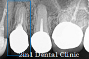 症例12 ソケットプリザベーション（抜歯窩保存法）＋ＧＢＲ（骨再生誘導法）併用