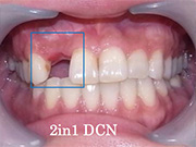 症例19　～GBR+CGF+AFG+歯肉移植+インビザライン併用～