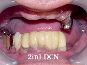 症例23　～ロケーター + 金属床義歯（チタン）～