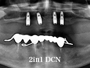 症例23　～ロケーター + 金属床義歯（チタン）～