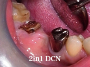 症例24　～歯槽骨再生誘導法（GBR）併用～