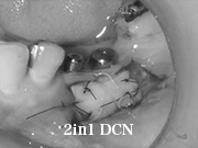 症例25　～歯槽骨再生誘導法（GBR）+ 歯肉移植 併用～