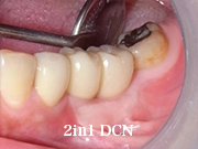 症例25　～歯槽骨再生誘導法（GBR）+ 歯肉移植 併用～