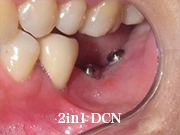 症例26　～歯槽骨再生誘導法（GBR）+ 歯肉移植 併用～