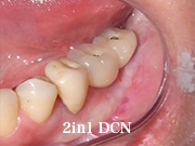 症例26　～歯槽骨再生誘導法（GBR）+ 歯肉移植 併用～