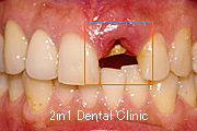 症例4　ソケットプリザベーション（抜歯窩保存法）＋ＧＢＲ（骨再生誘導法）＋歯肉移植　併用