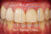 症例4　ソケットプリザベーション（抜歯窩保存法）＋ＧＢＲ（骨再生誘導法）＋歯肉移植　併用