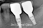 症例5　ＧＢＲ（骨再生誘導法）＋歯肉移植　併用